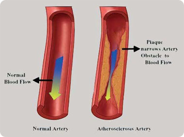 Ateroscleroza